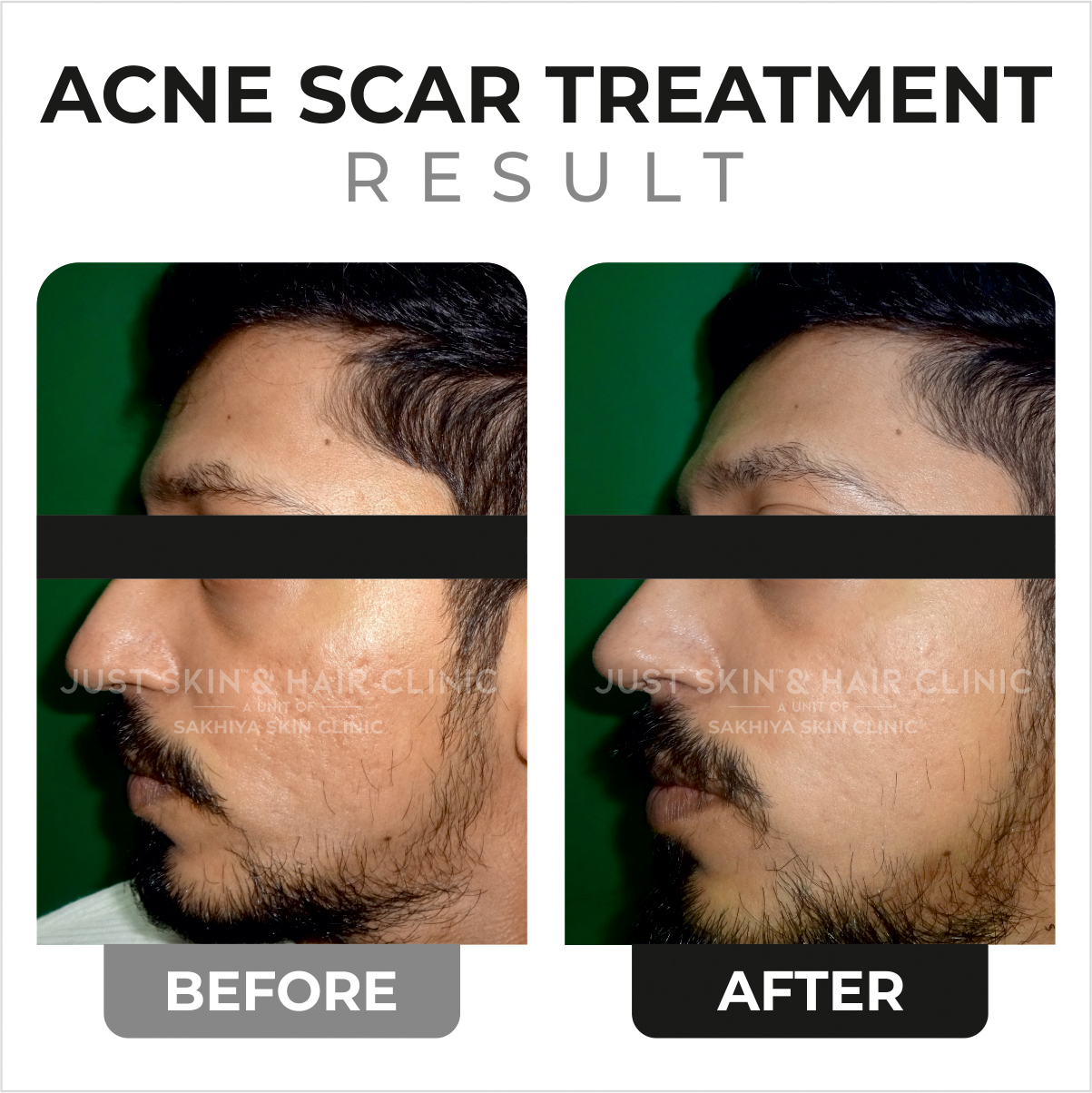 Acne Scar Treatment Before and After Result (1)