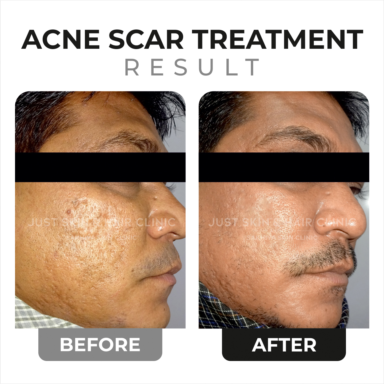 Acne Scar Treatment Before and After Result (2)