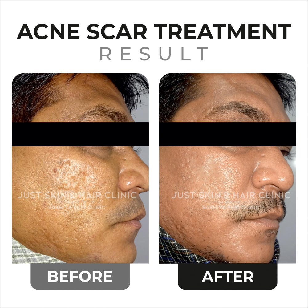 Acne Scar Treatment Before and After Result at Just Skin & Hair Clinic (5)