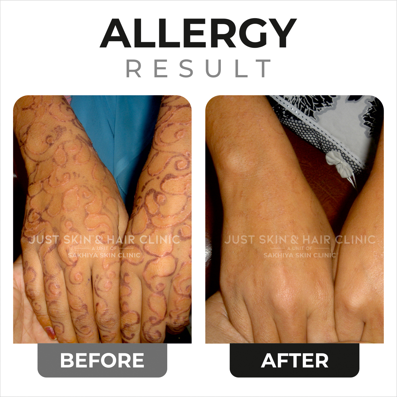 Allerggy Treatment Before and After Result at Just Skin & Hair Clinic (1)