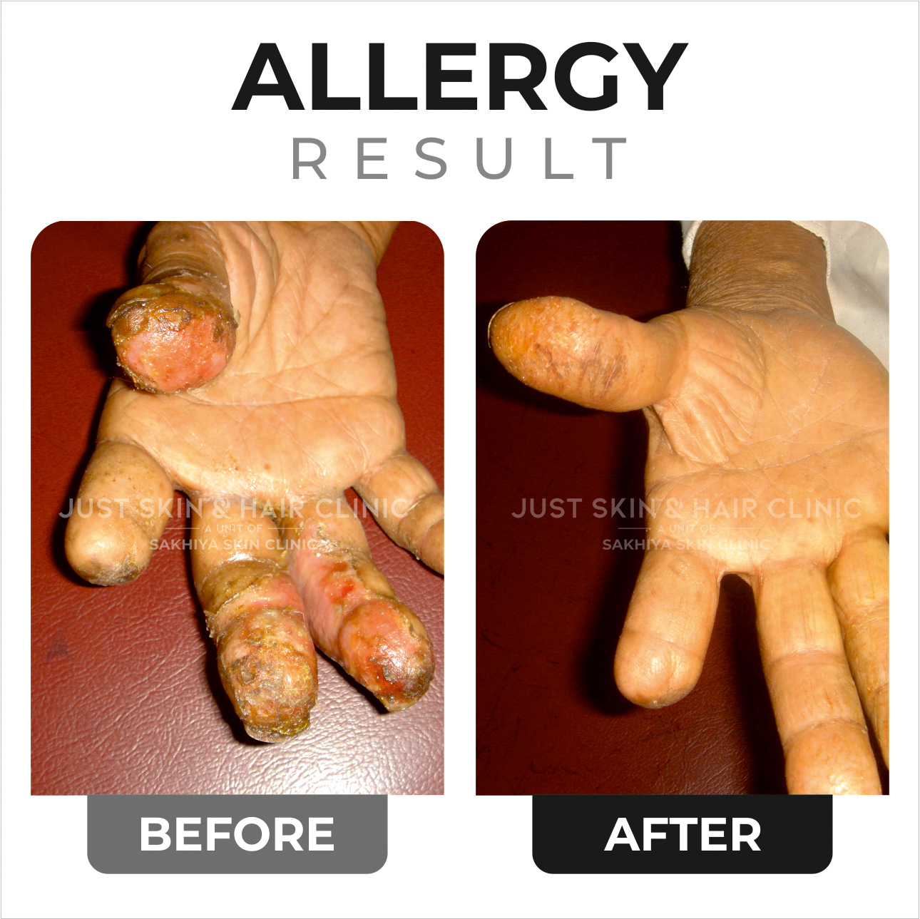 Allerggy Treatment Before and After Result at Just Skin & Hair Clinic (2)