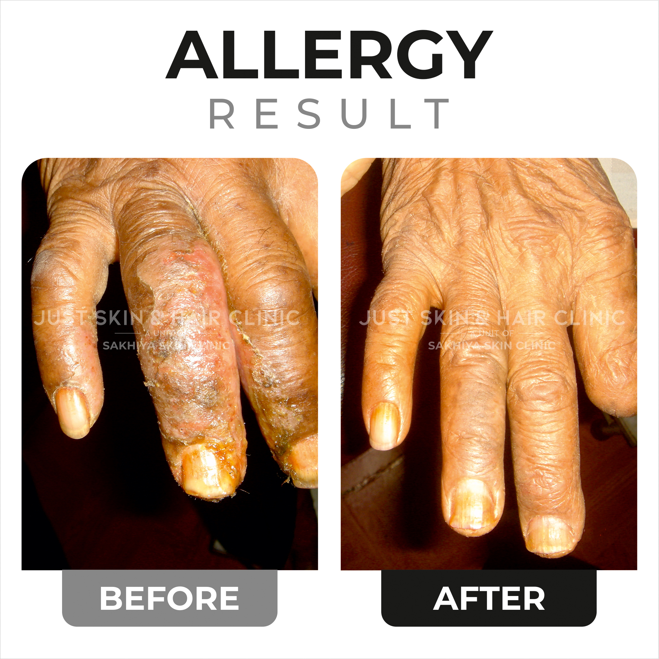 Allergy Treatment Before and After Result (3)