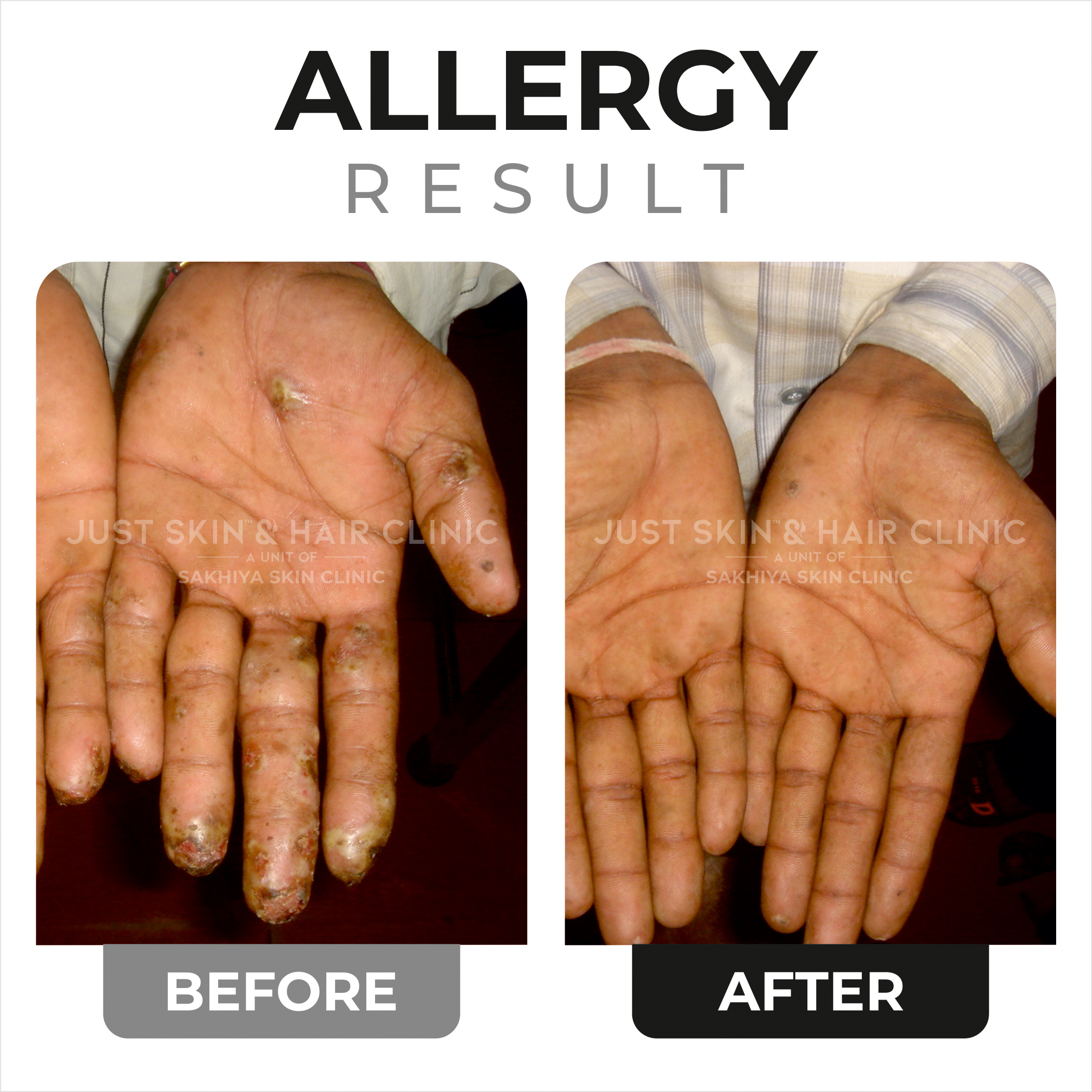 Allergy Treatment Before and After Result (5)