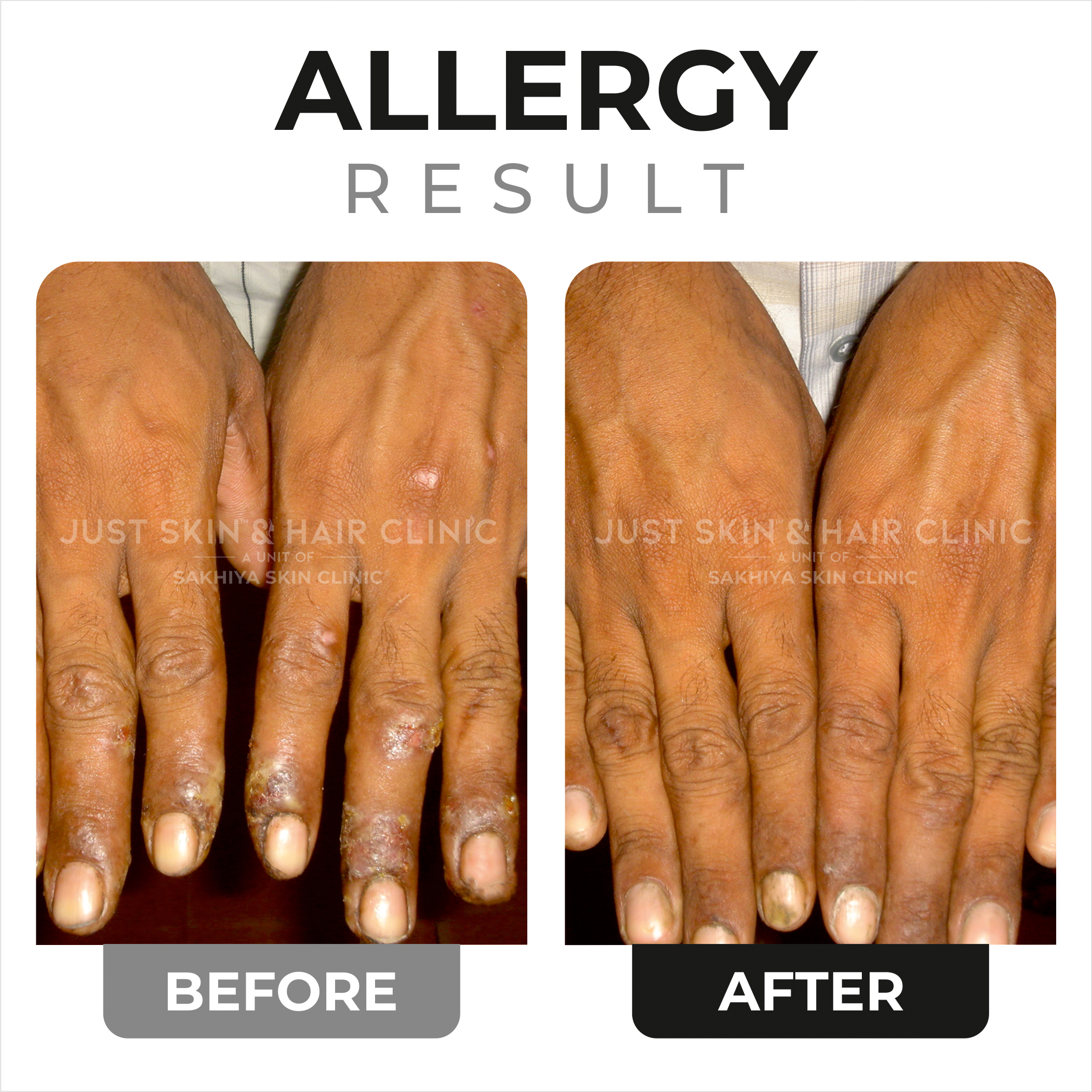 Allergy Treatment Before and After Result (6)