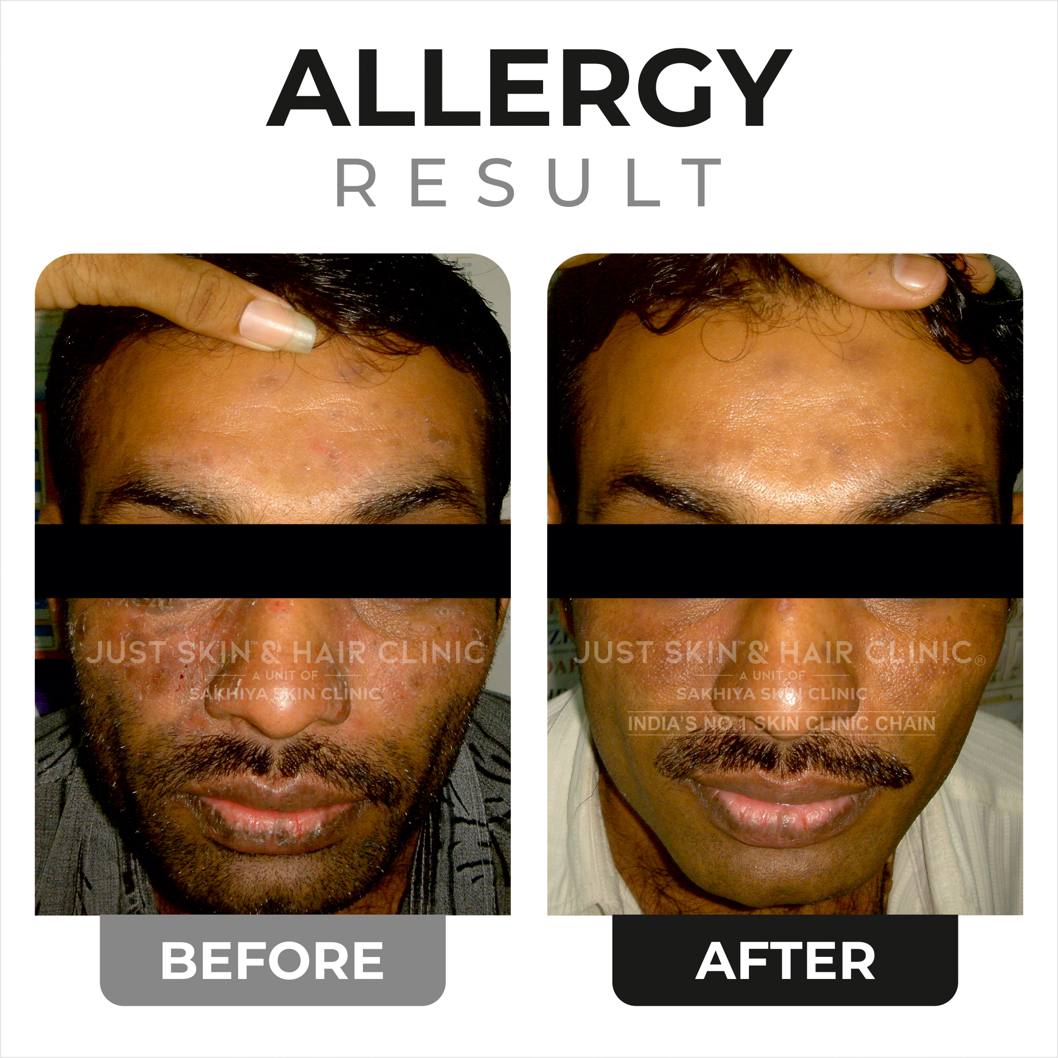 Allergy Treatment Before and After Result (7)