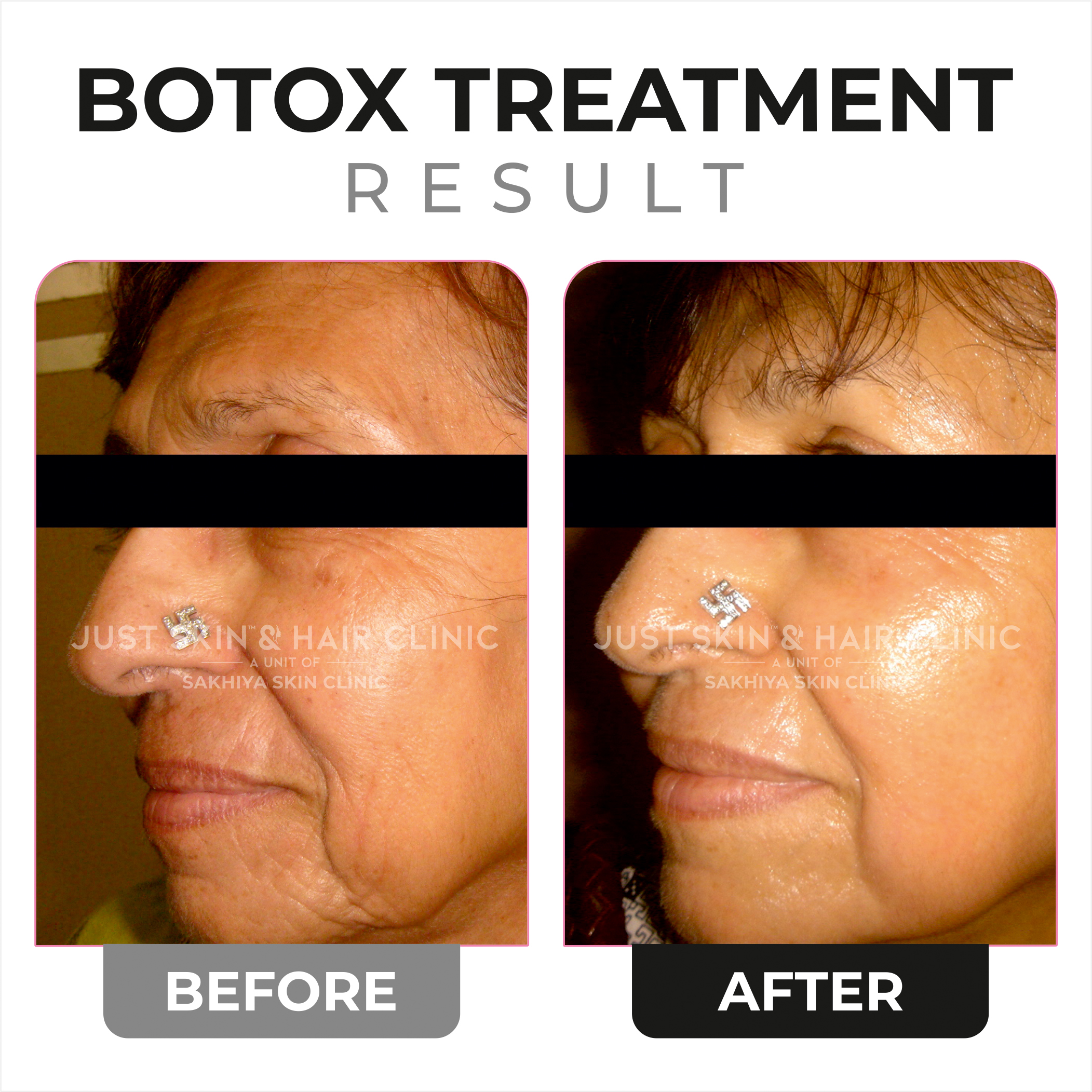 Botox Treatment Before and After Result (1)