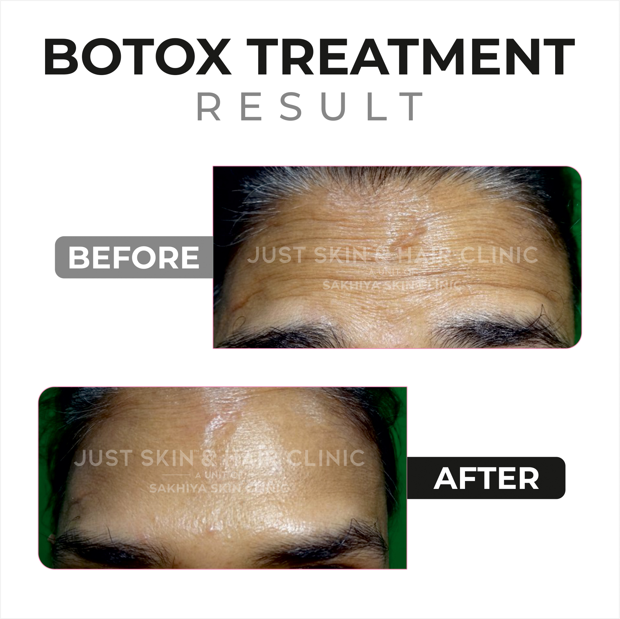 Botox Treatment Before and After Result (2)