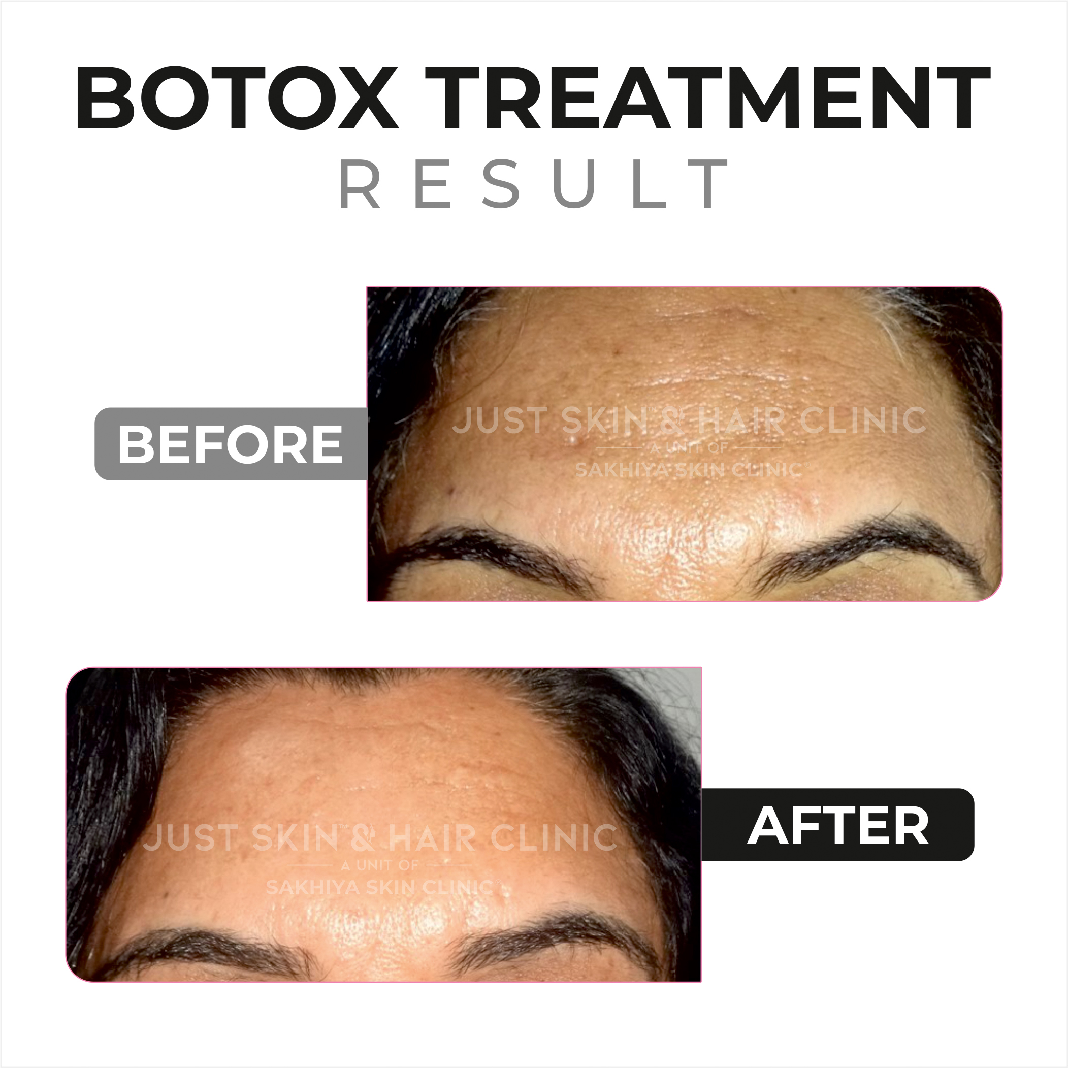 Botox Treatment Before and After Result (3)