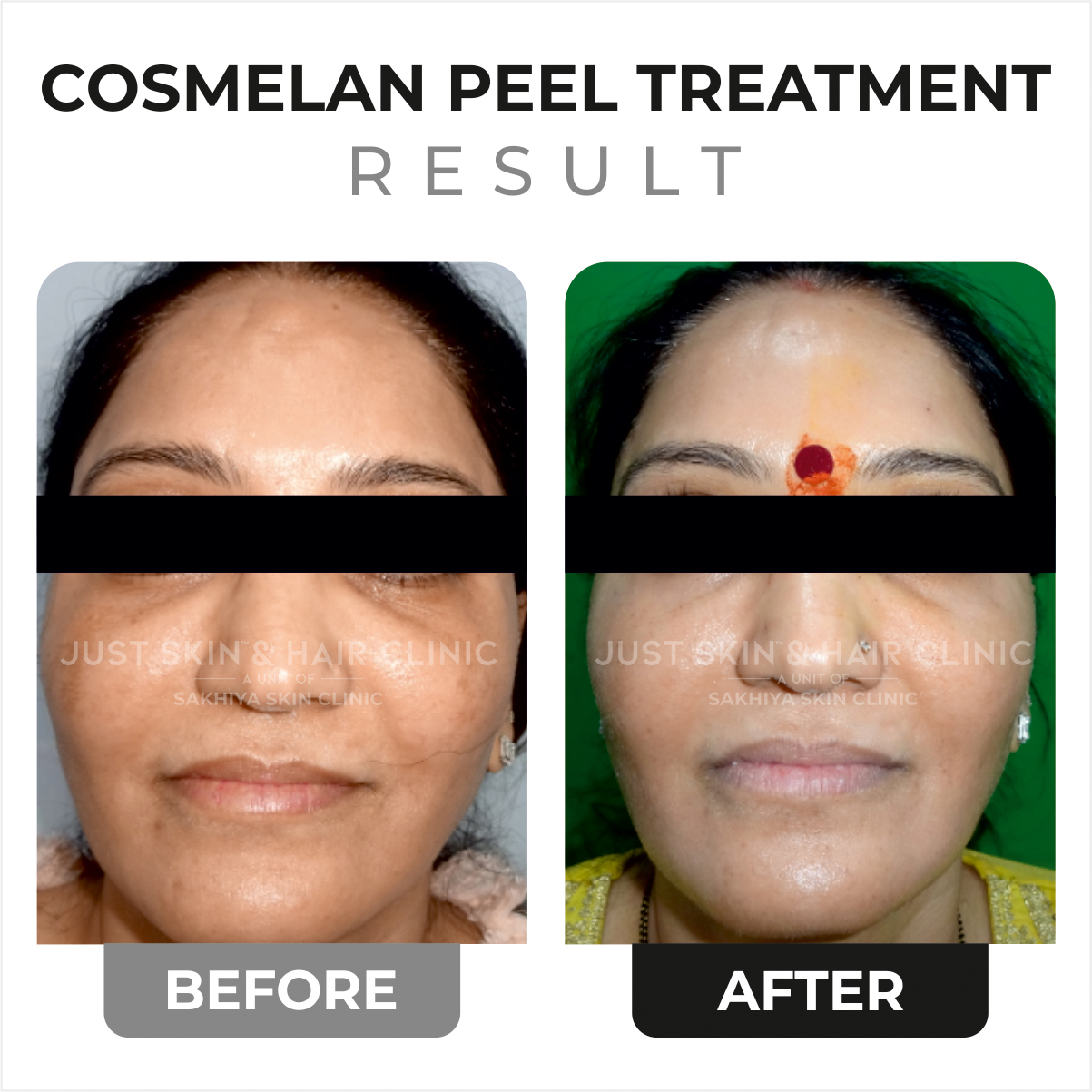 Cosmelan Peel Before and After Result (1)