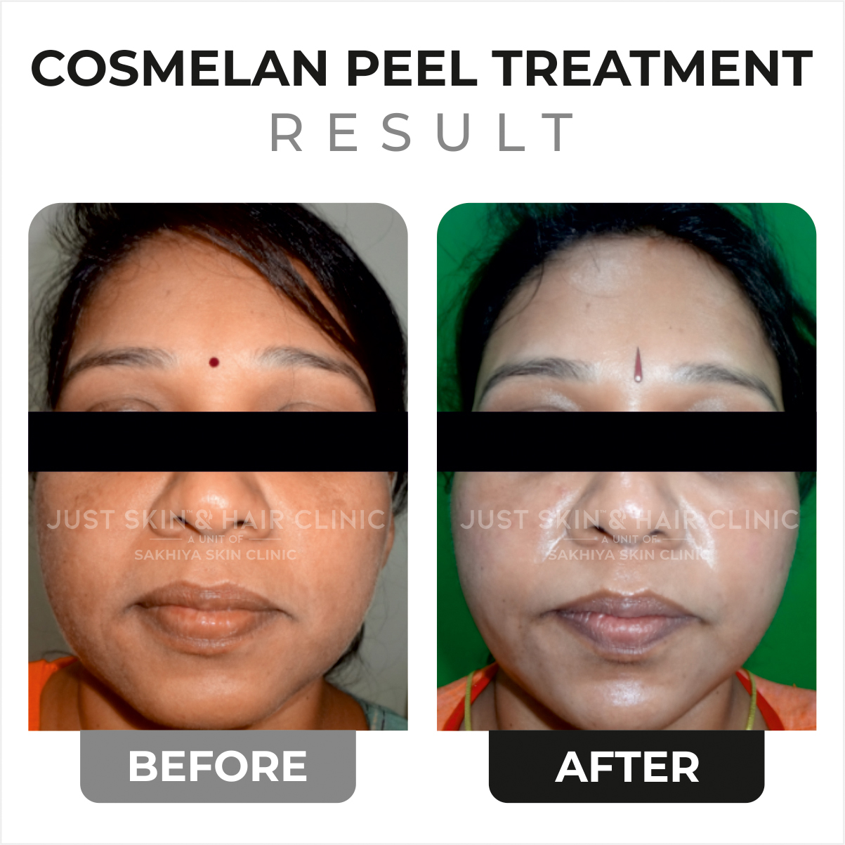 Cosmelan Peel Before and After Result (2)