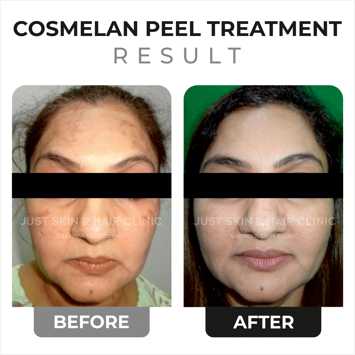 Cosmelan Peel Before and After Result (3)