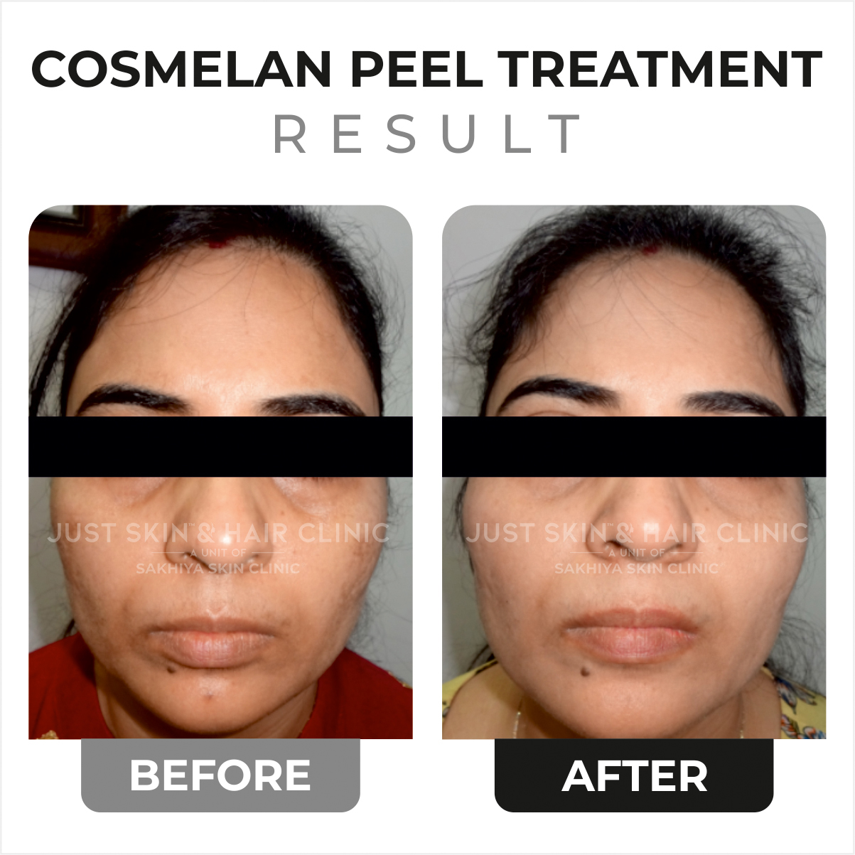 Cosmelan Peel Before and After Result (4)