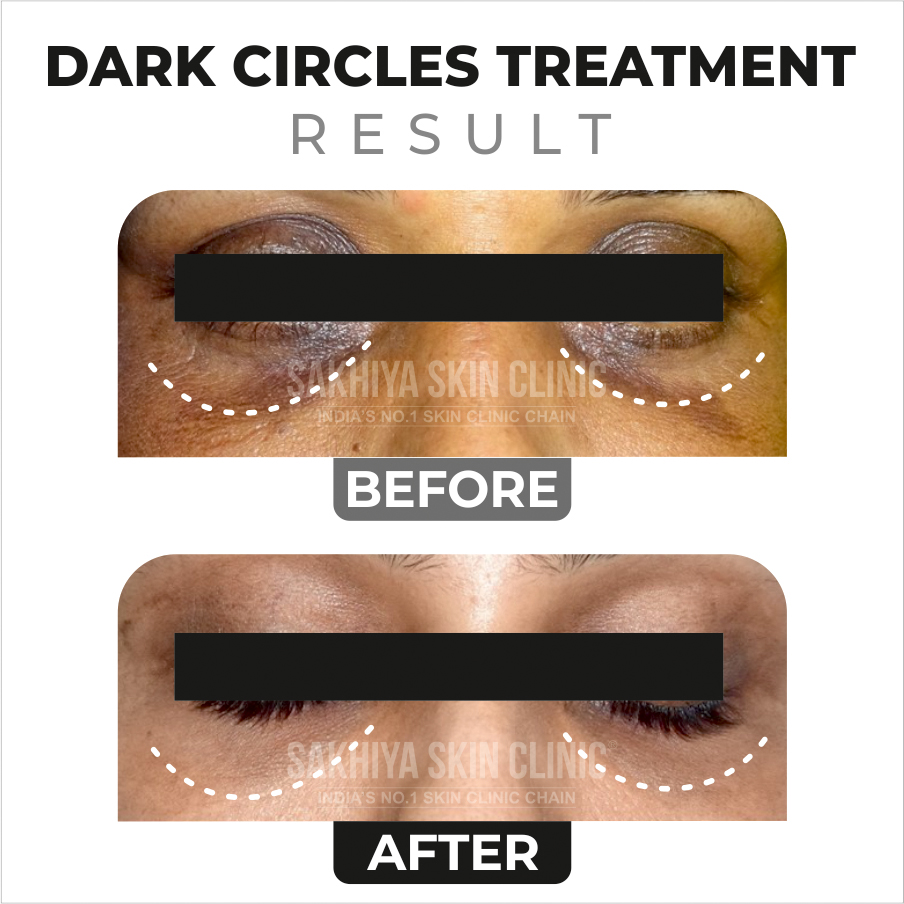 Dark Circles Treatment Before and After Result at Just Skin & Hair Clinic (1)