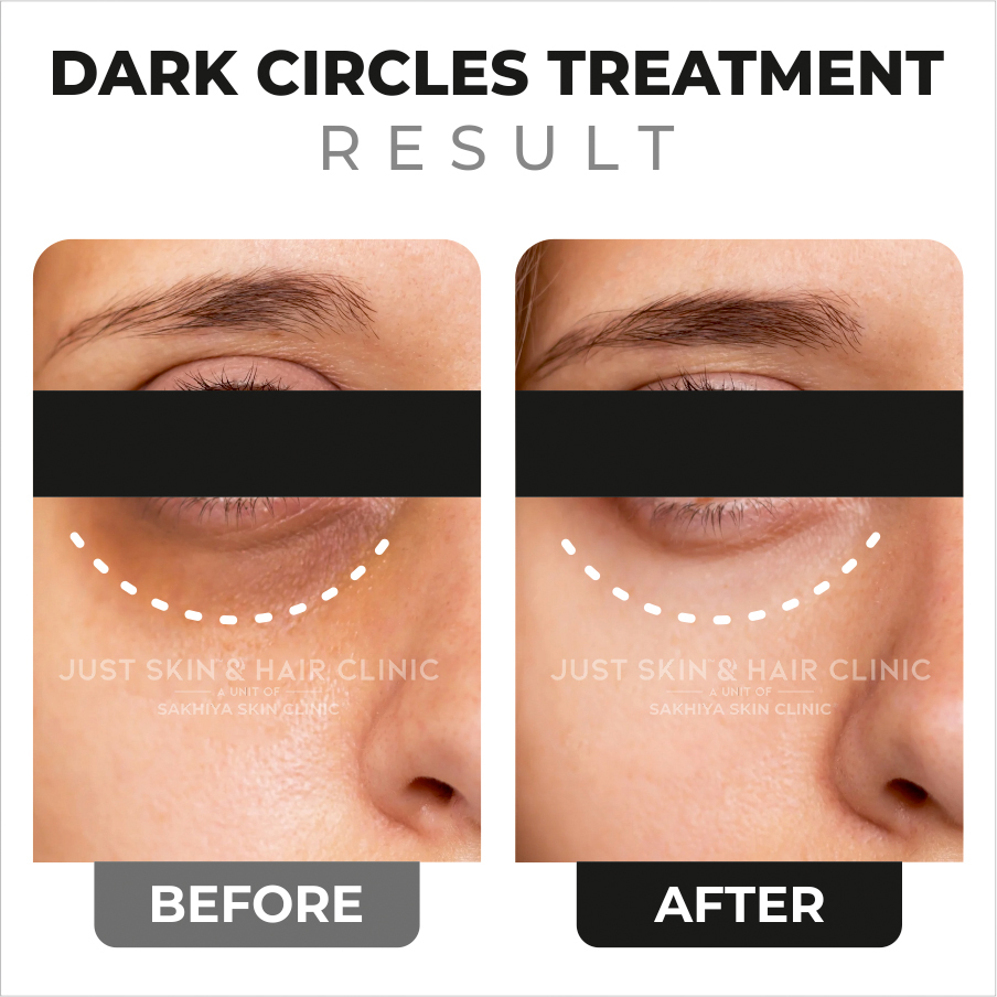 Dark Circles Treatment Before and After Result at Just Skin & Hair Clinic (2)