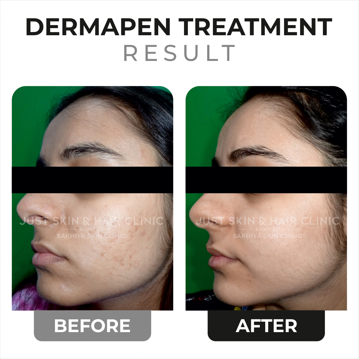 Dermapen Treatment Before and After Result (2)