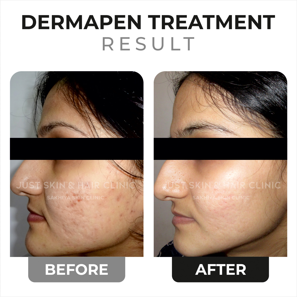 Dermapen Treatment Before and After Result