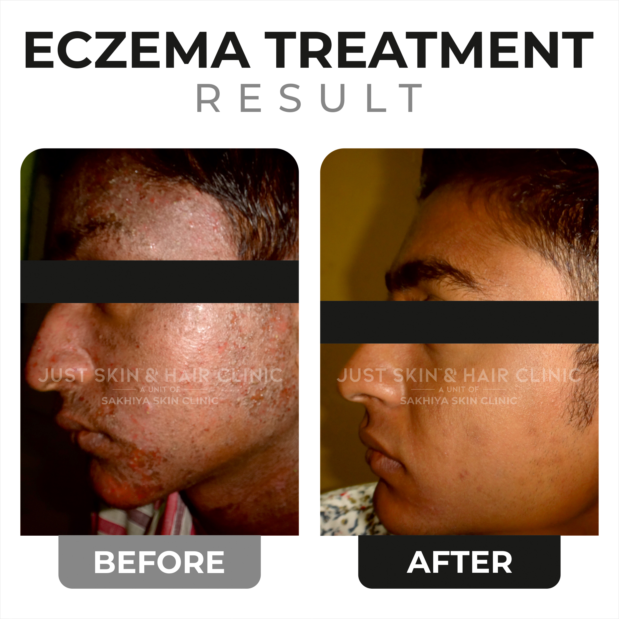 Eczema Treatment Before and After (1)