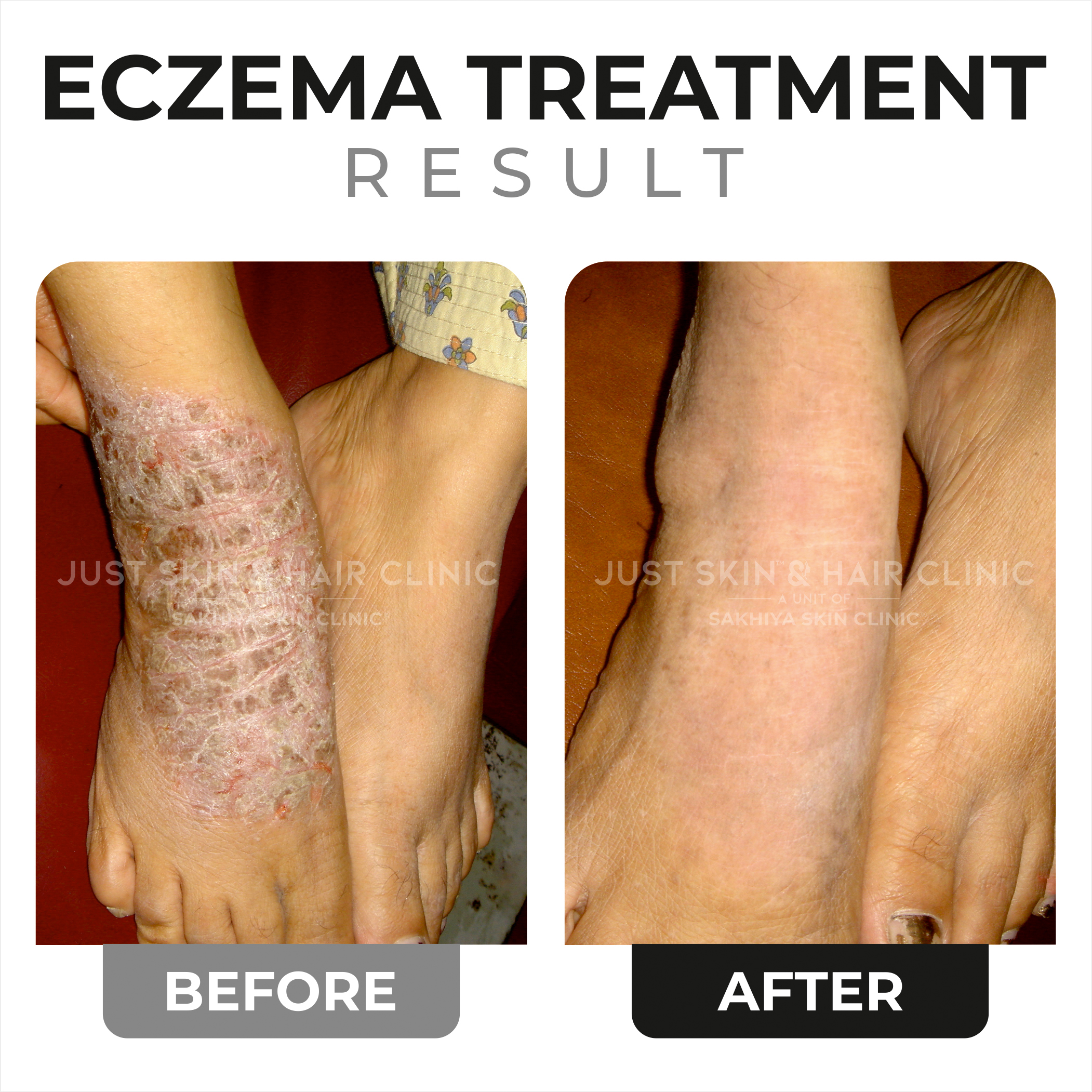 Eczema Treatment Before and After (2)