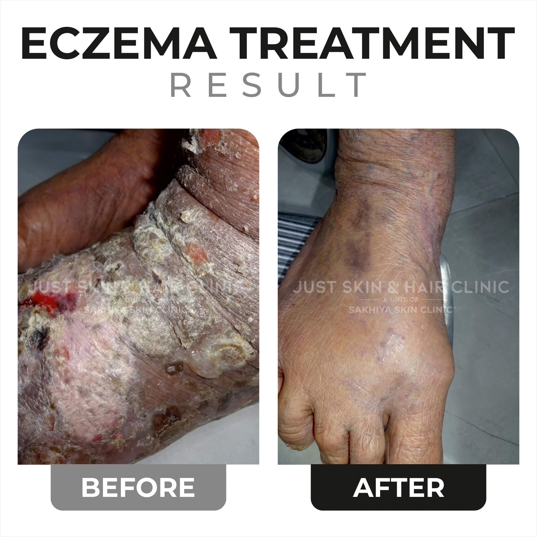 Eczema Treatment Before and After (3)