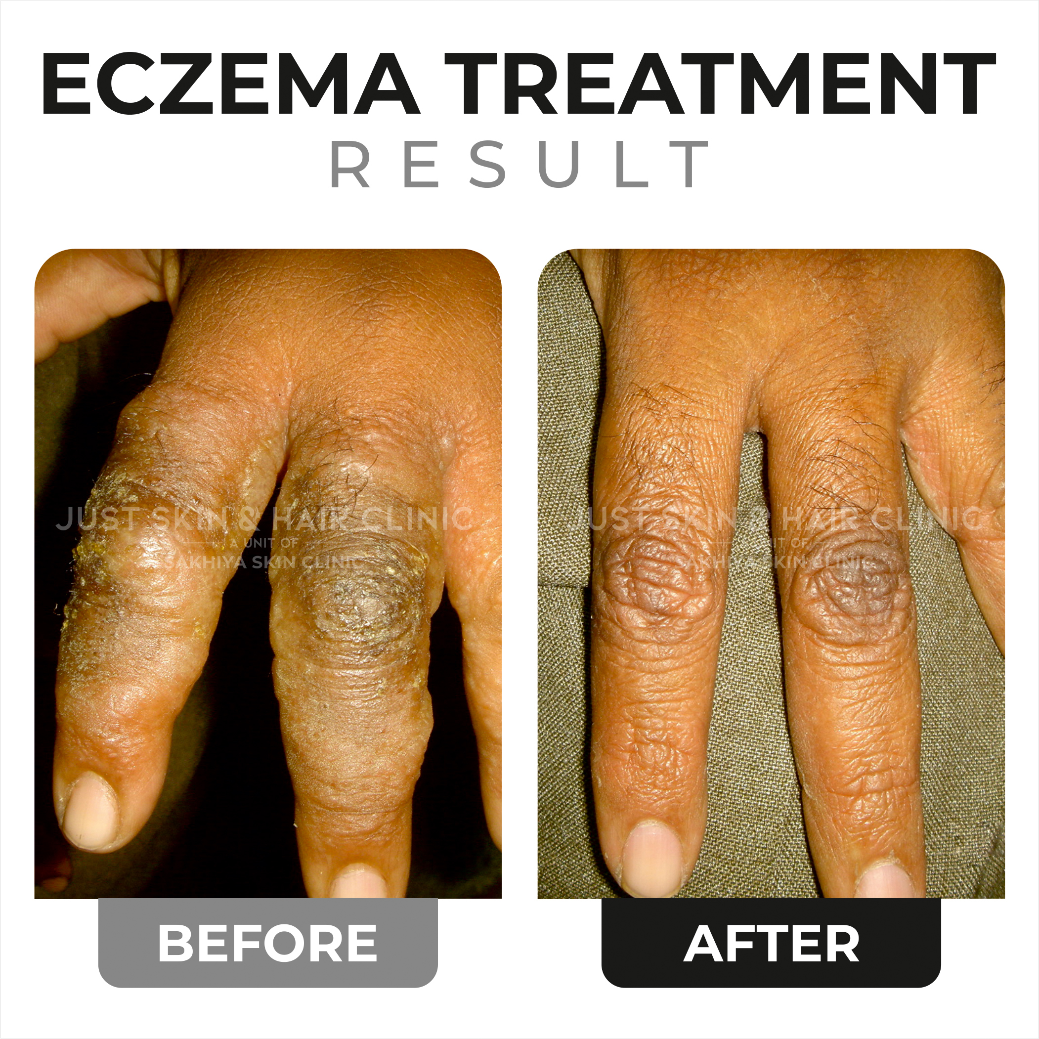 Eczema Treatment Before and After (4)