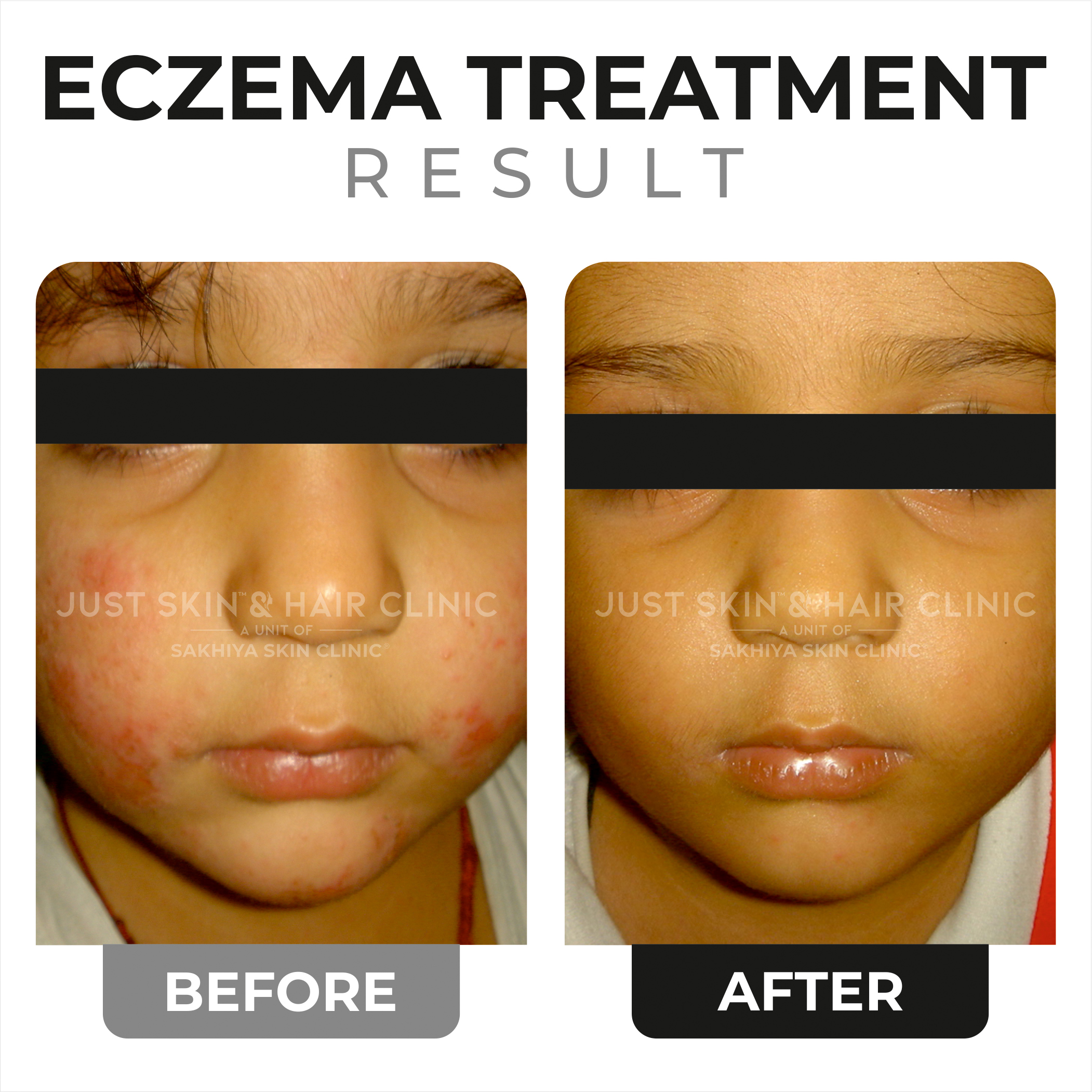 Eczema Treatment Before and After (5)