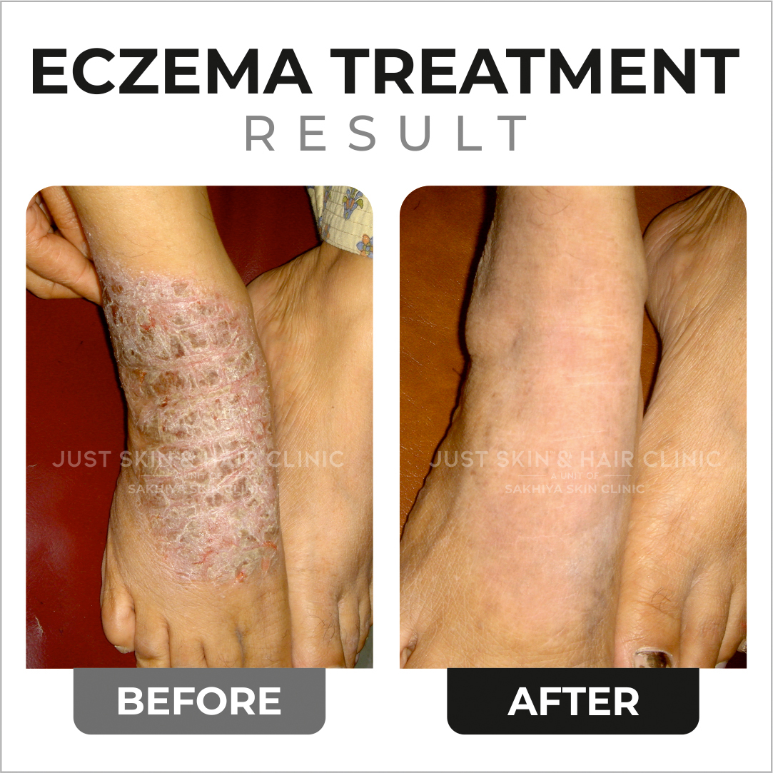 Eczema Treatment Before and After Result at Just Skin & Hair Clinic (1)