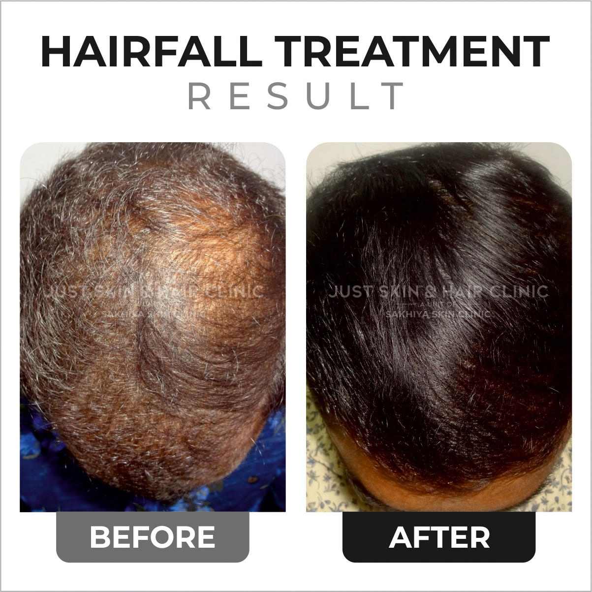 Hairfall Treatment Before and After Result at Just Skin & Hair Clinic (1)