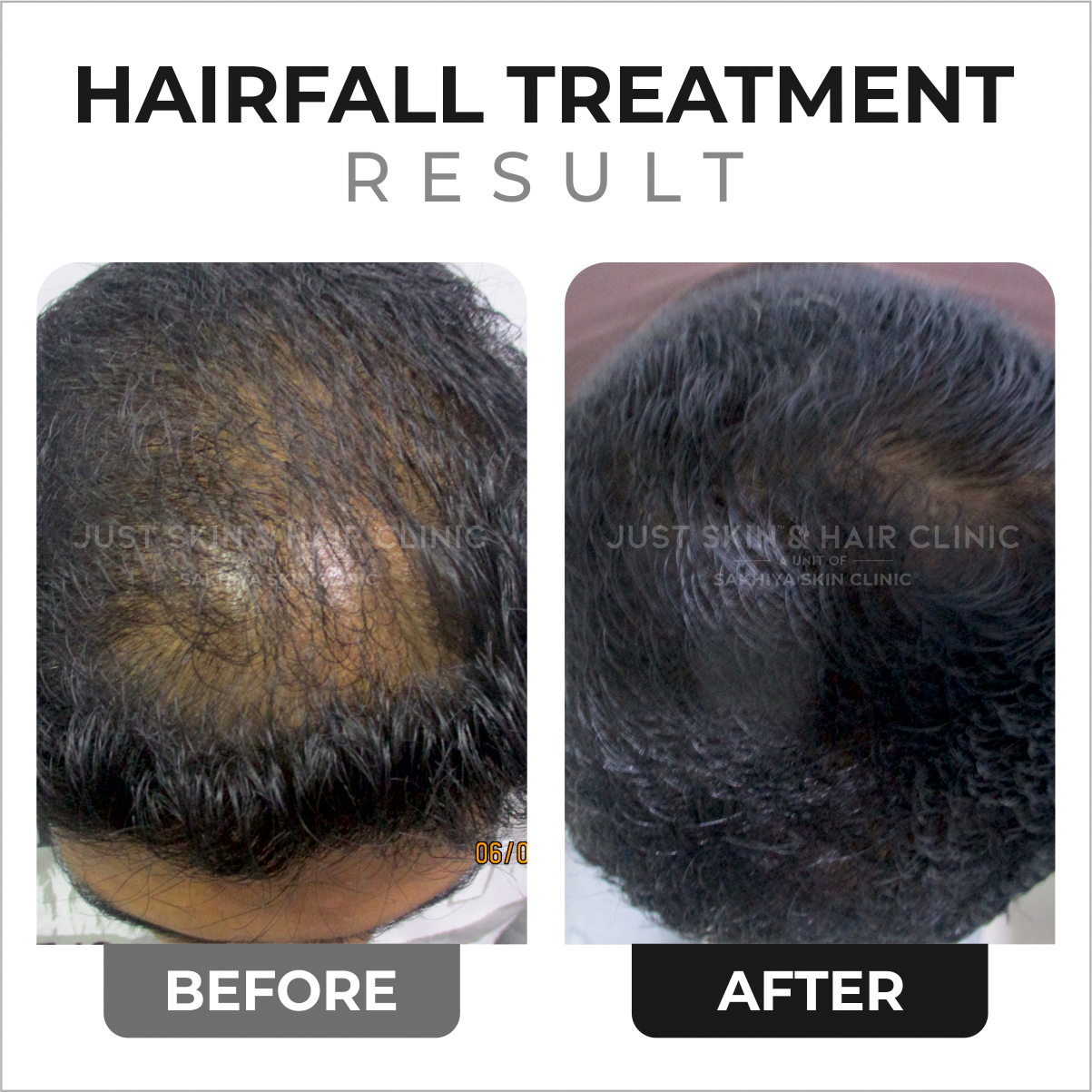 Hairfall Treatment Before and After Result at Just Skin & Hair Clinic (2)