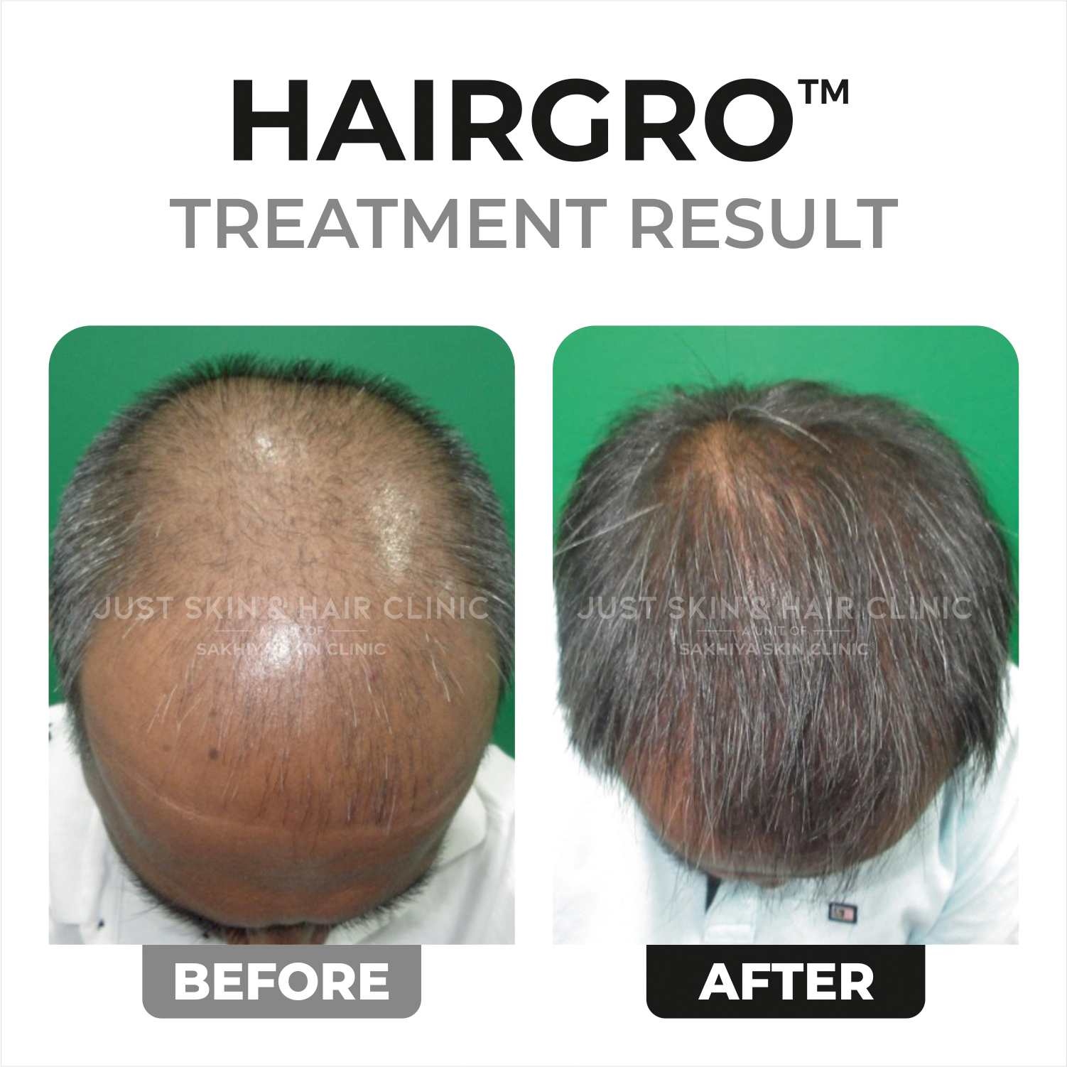 Hairgro Treatment Before and After Result (1)