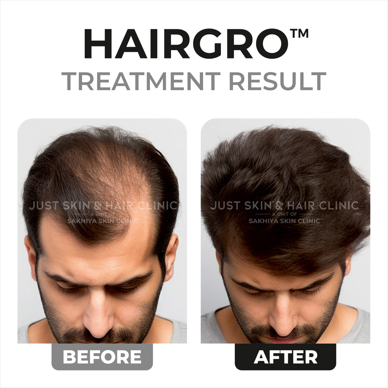 Hairgro Treatment Before and After Result (2)