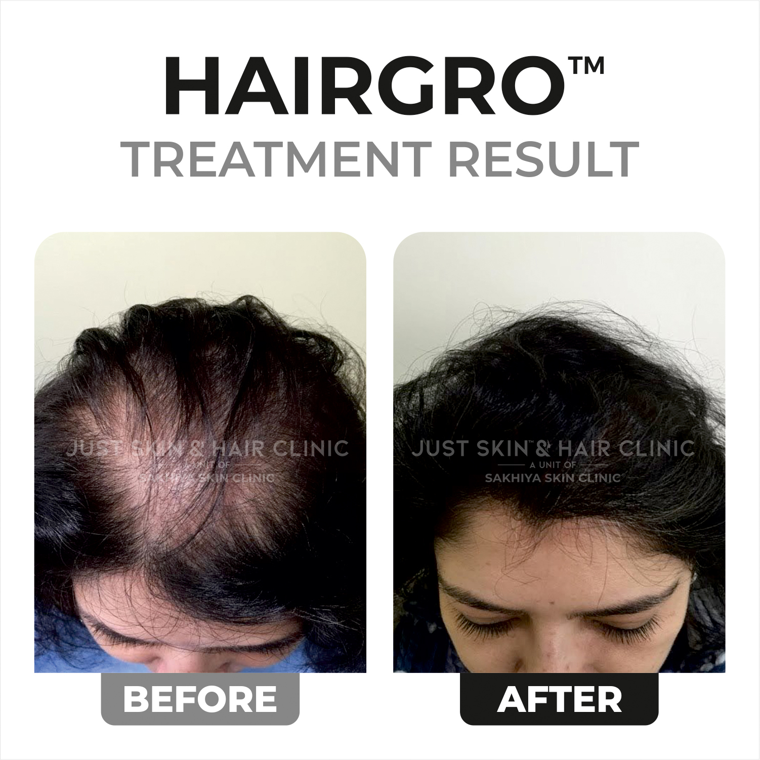 Hairgro Treatment Before and After Result (3)