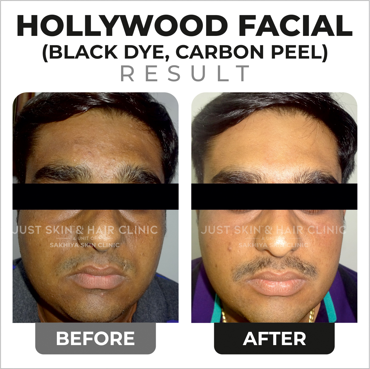 Hollywood Facial Treatment Before and After Result at Just Skin & Hair Clinic (1)