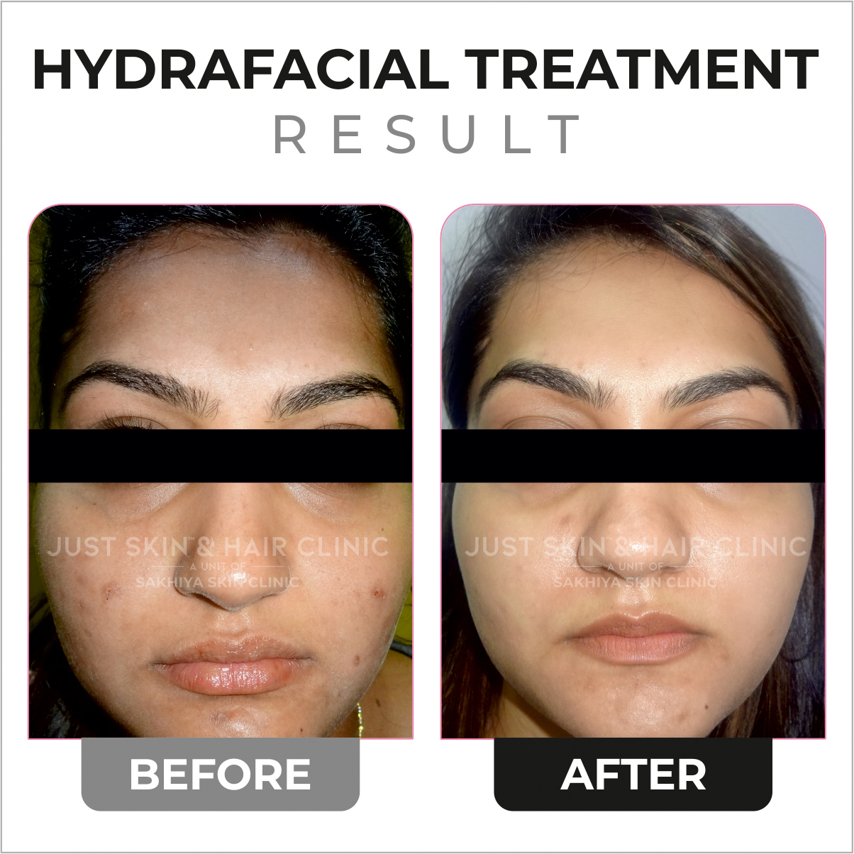 Hydrafacial Treatment Before and After Result (1)