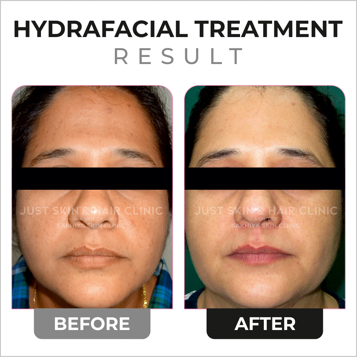 Hydrafacial Treatment Before and After Result (3)