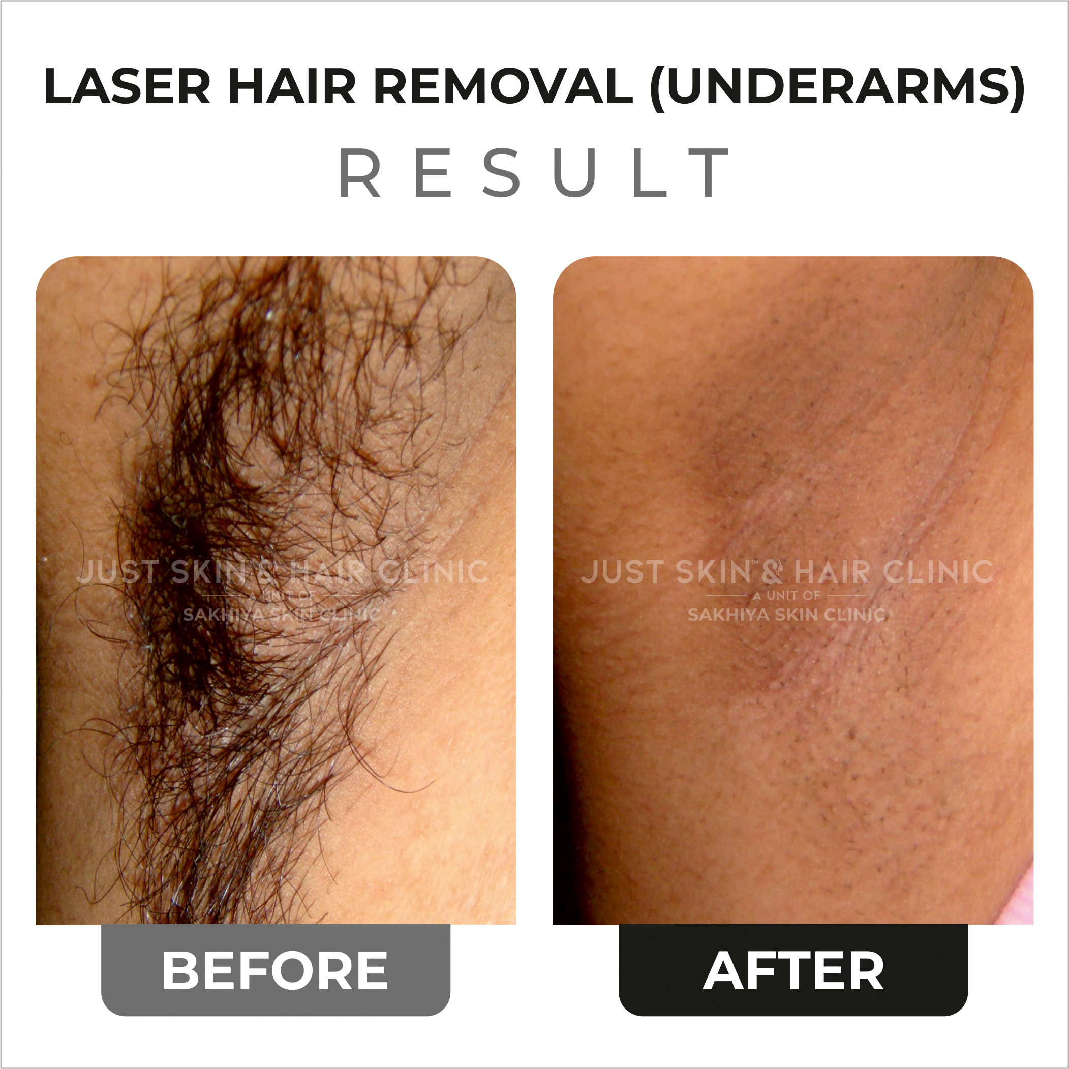 Laser Hair Removal Before and After Result (1)