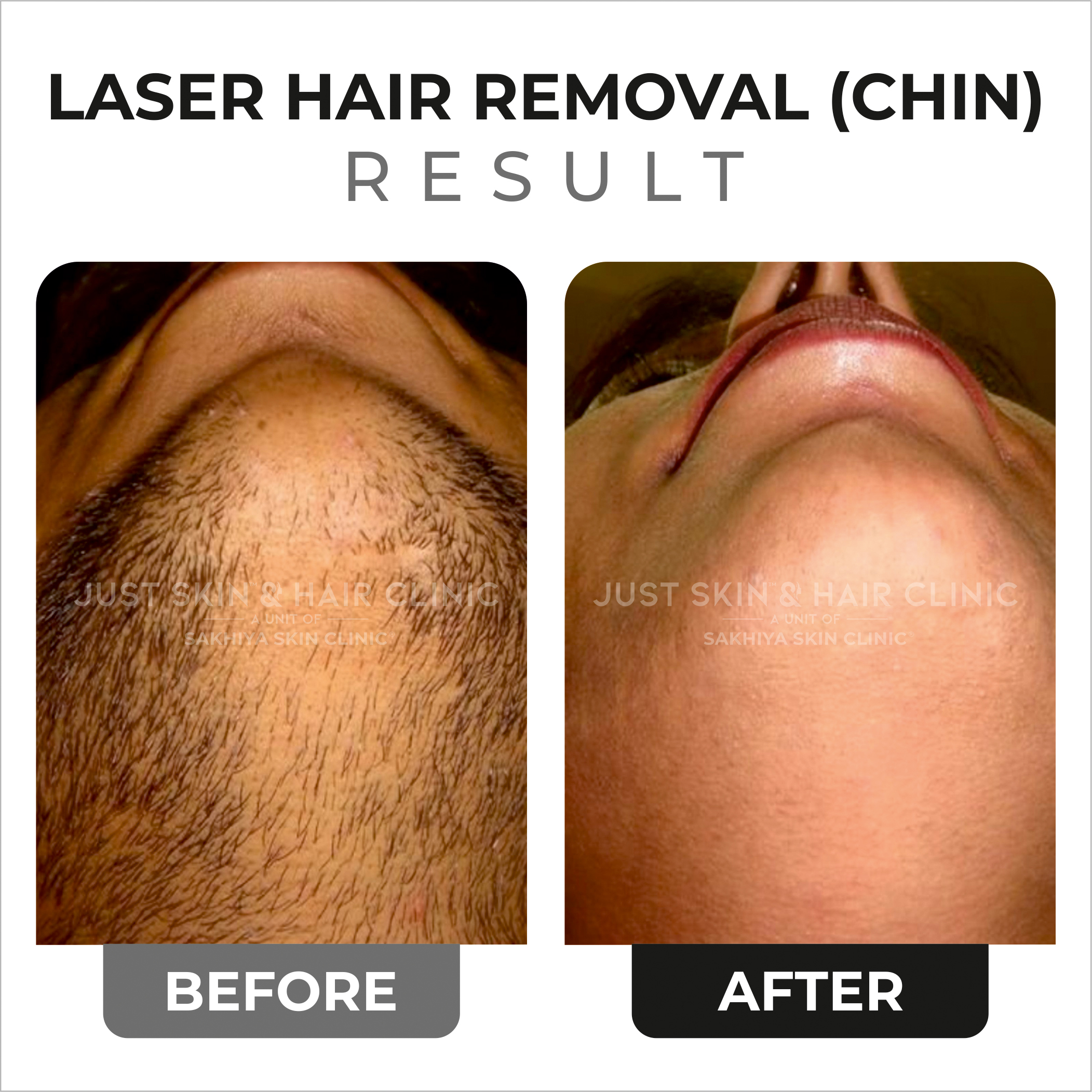 Laser Hair Removal Before and After Result (2)