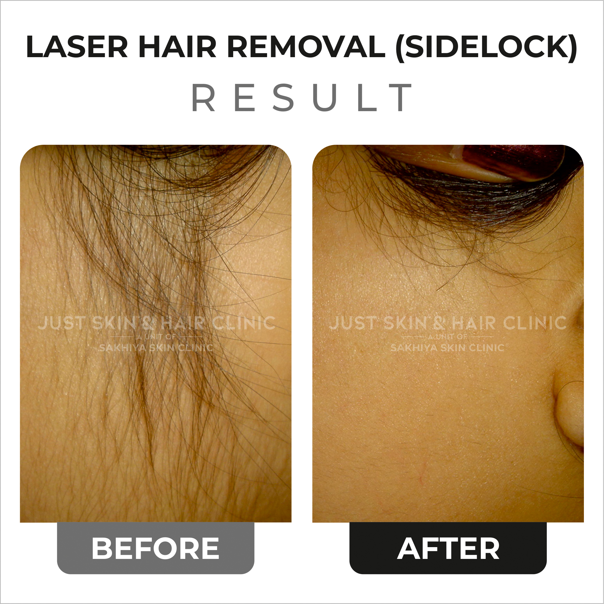 Laser Hair Removal Before and After Result (3)