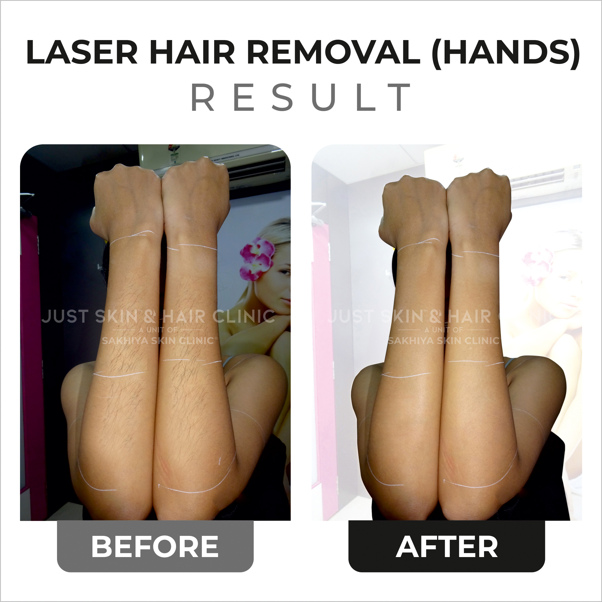 Laser Hair Removal Before and After Result (4)