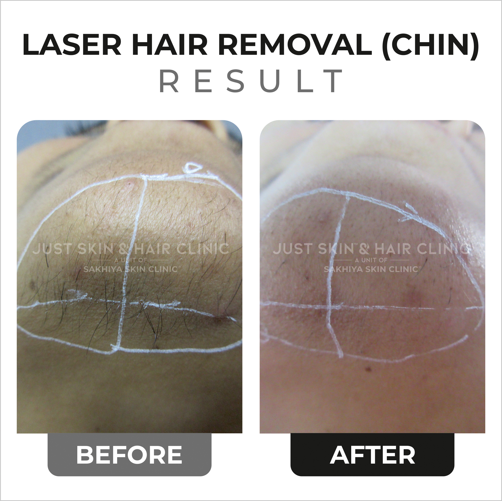 Laser Hair Removal Before and After Result (5)