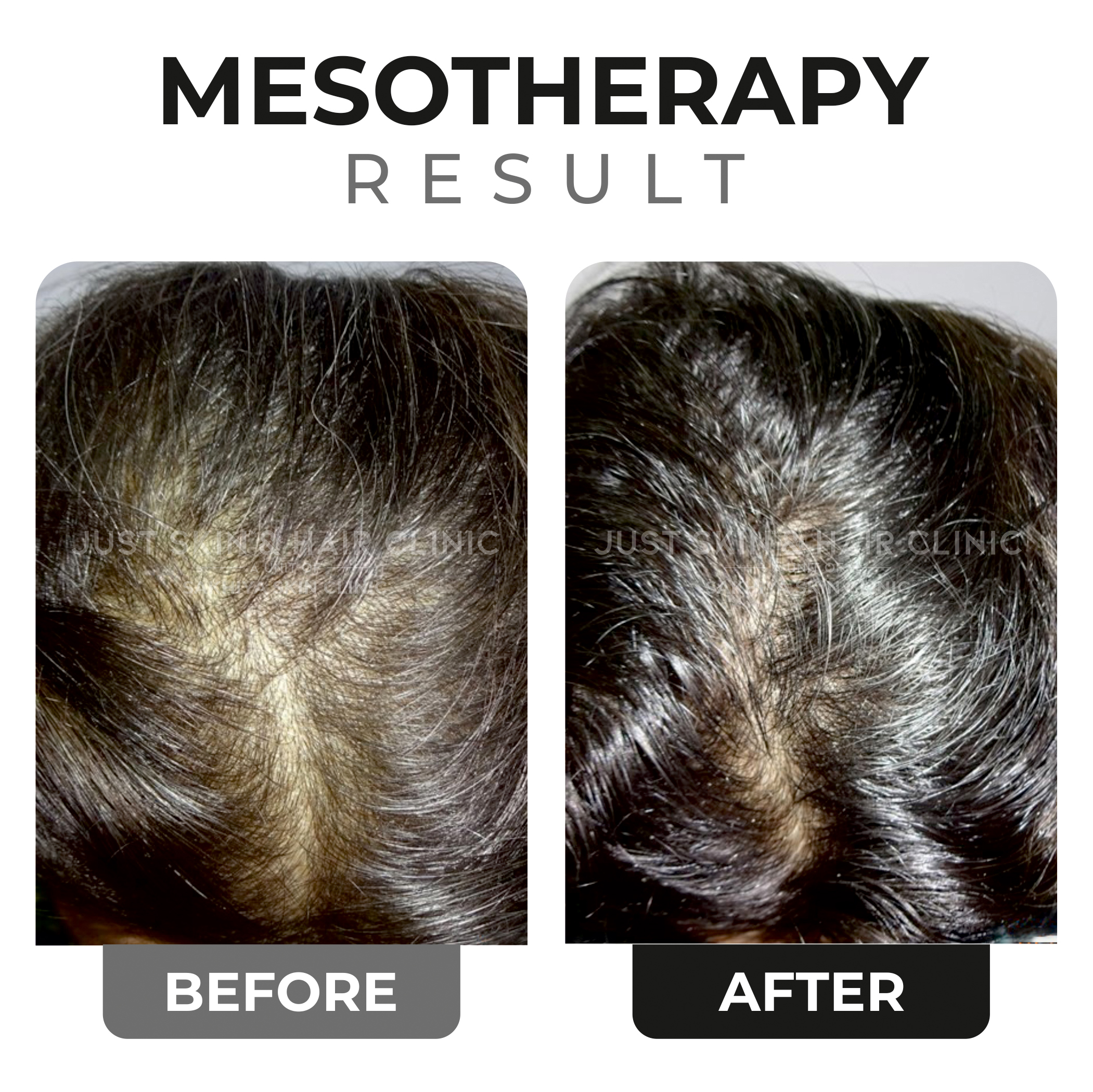 Mesotherapy Before and After Result (1)