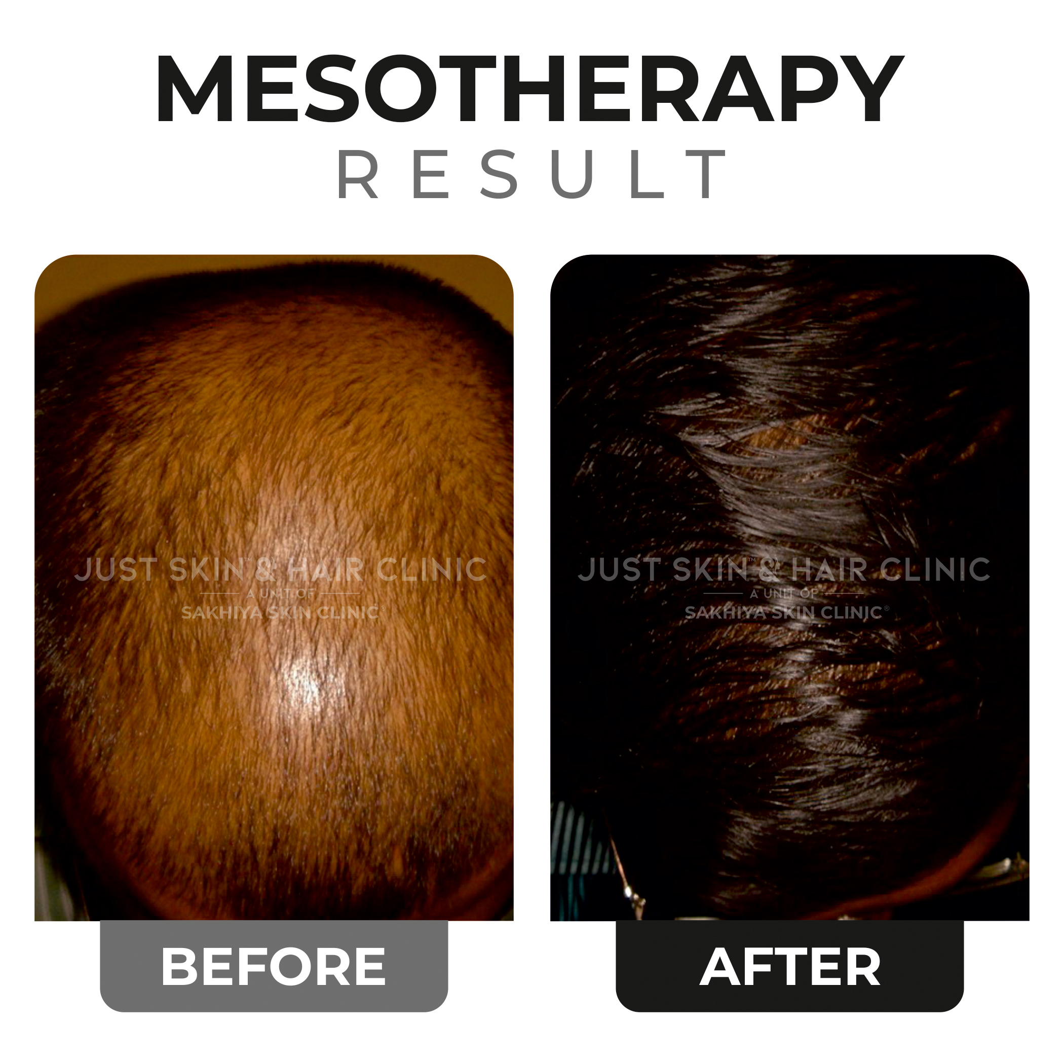 Mesotherapy Before and After Result (2)