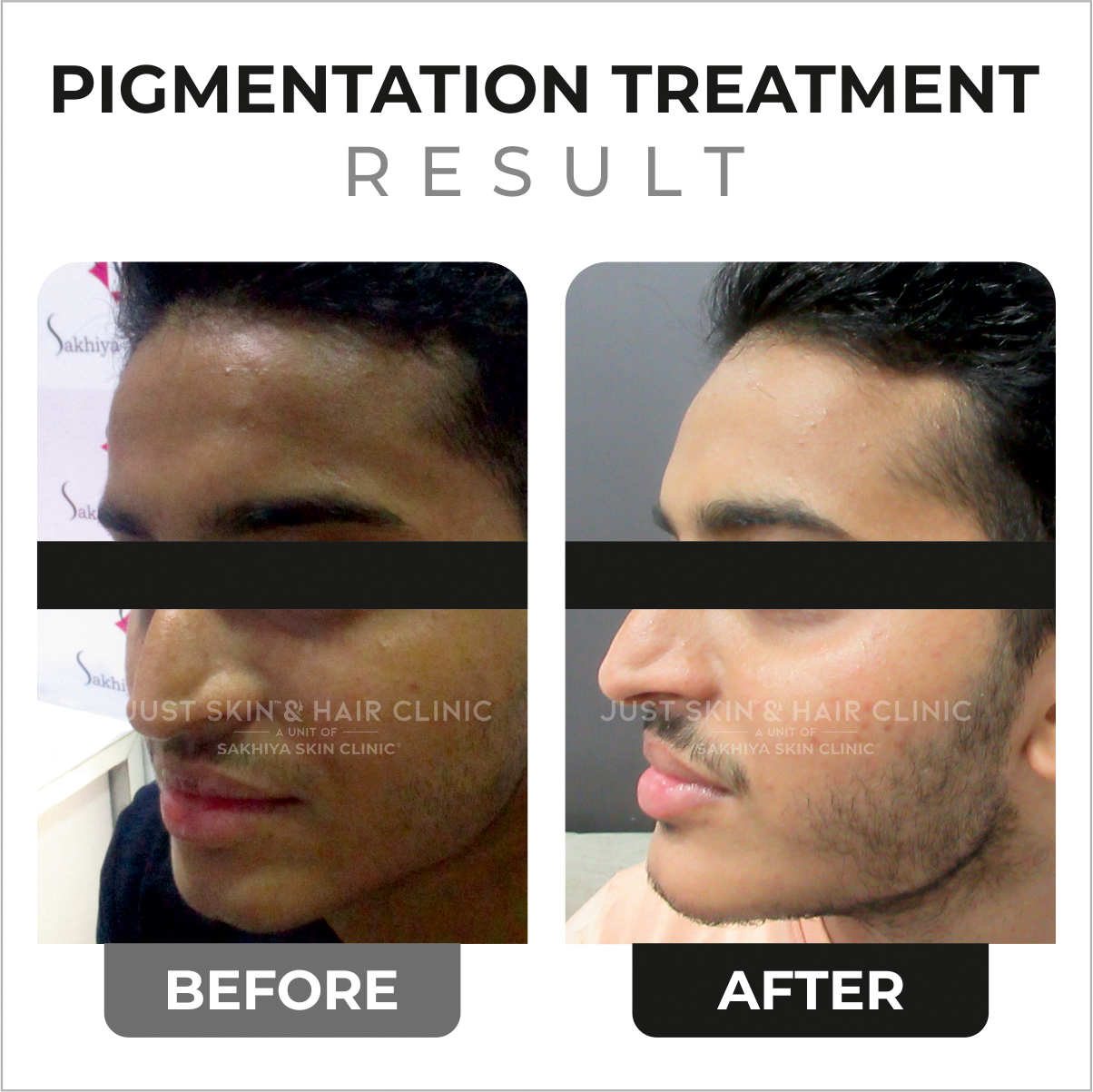 Pigmentation Treatment Before and After Result at Just Skin & Hair Clinic (1)