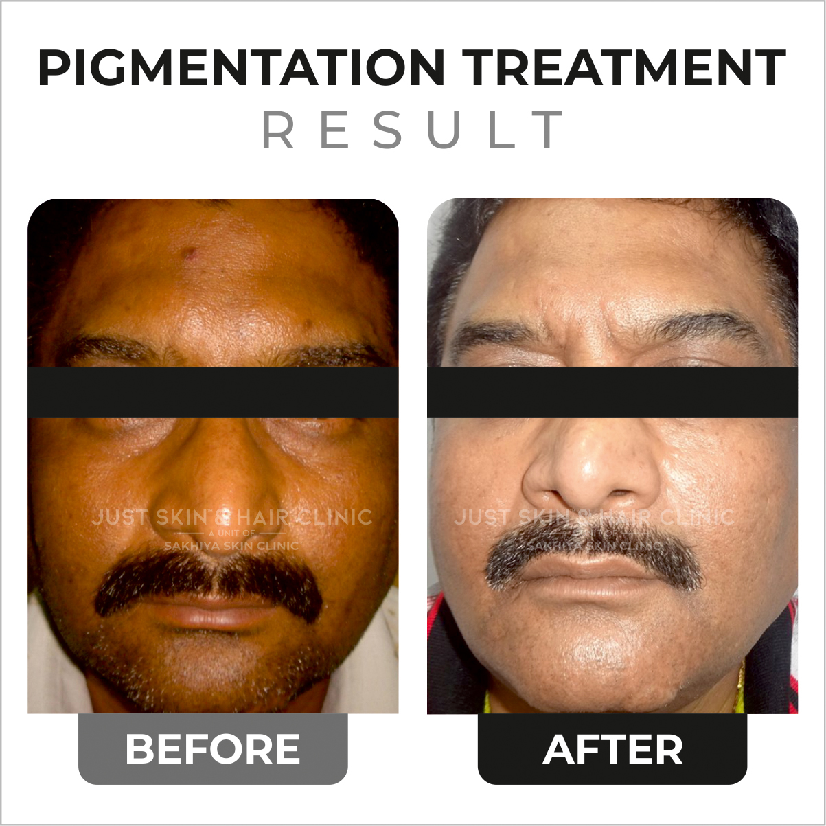 Pigmentation Treatment Before and After Result at Just Skin & Hair Clinic (8)