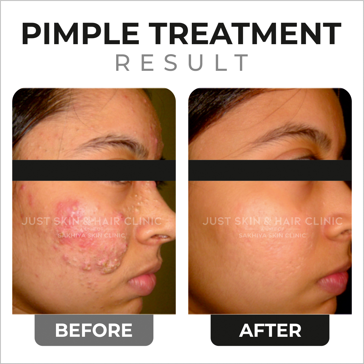 Pimple Treatment Before and After Result at Just Skin & Hair Clinic (1)