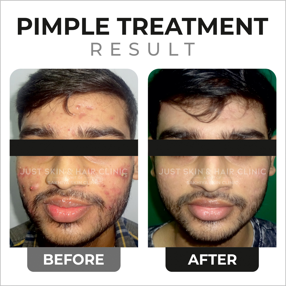 Pimple Treatment Before and After Result at Just Skin & Hair Clinic (2)