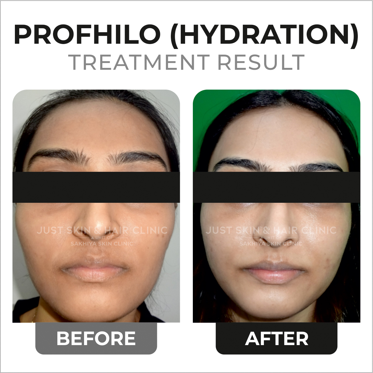 Profhilo Hydration Treatment Before and After Result at Just Skin & Hair Clinic (1)