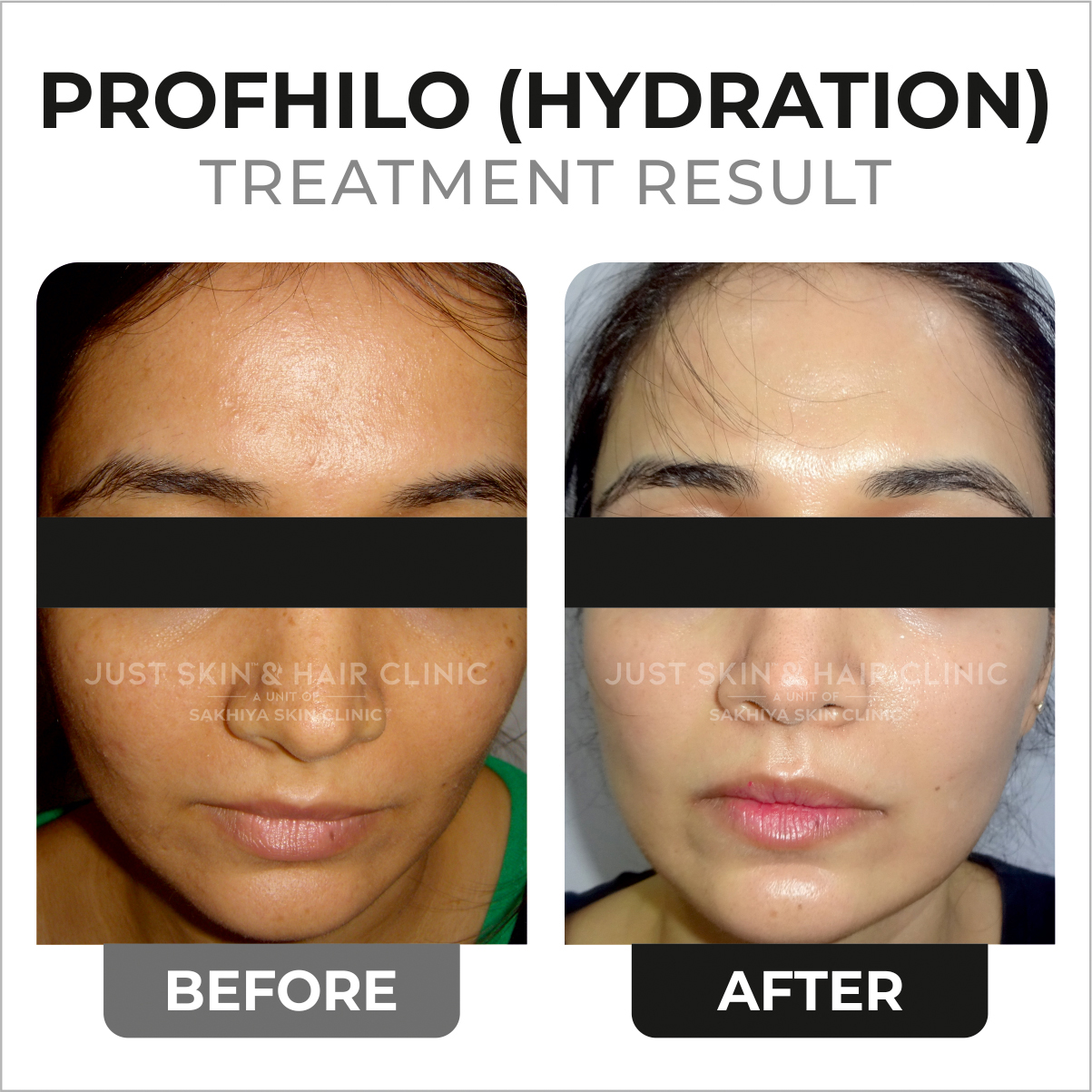 Profhilo Hydration Treatment Before and After Result at Just Skin & Hair Clinic (2)