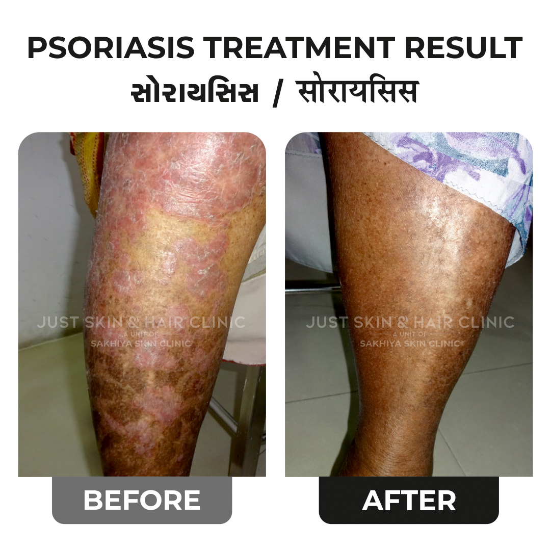 Psoriasis Treatment Before and After Result at Just Skin & Hair Clinic (1)