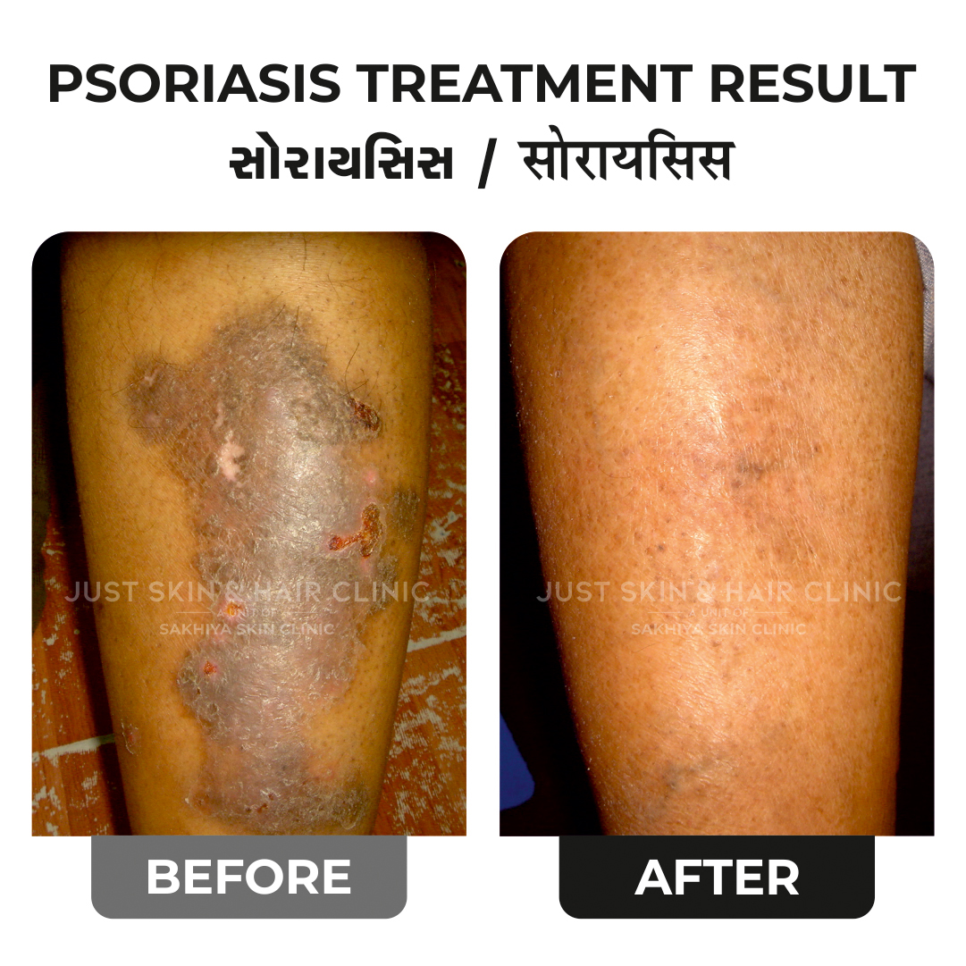 Psoriasis Treatment Before and After Result at Just Skin & Hair Clinic (4)