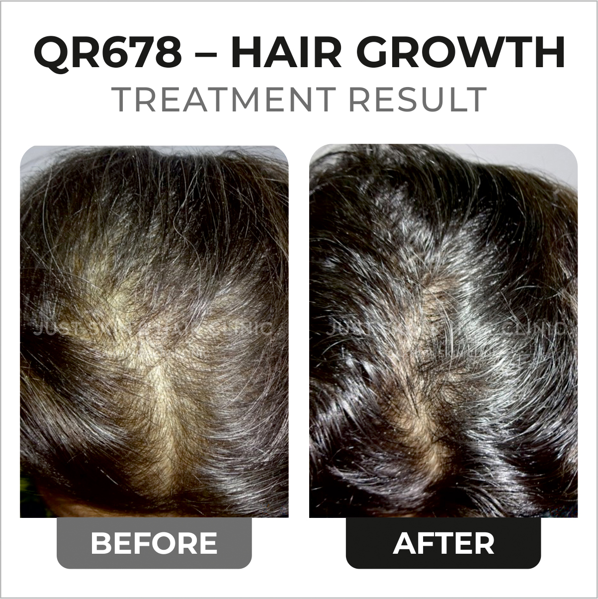 QR678 – HAIR GROWTH Treatment Before and After Result (1)